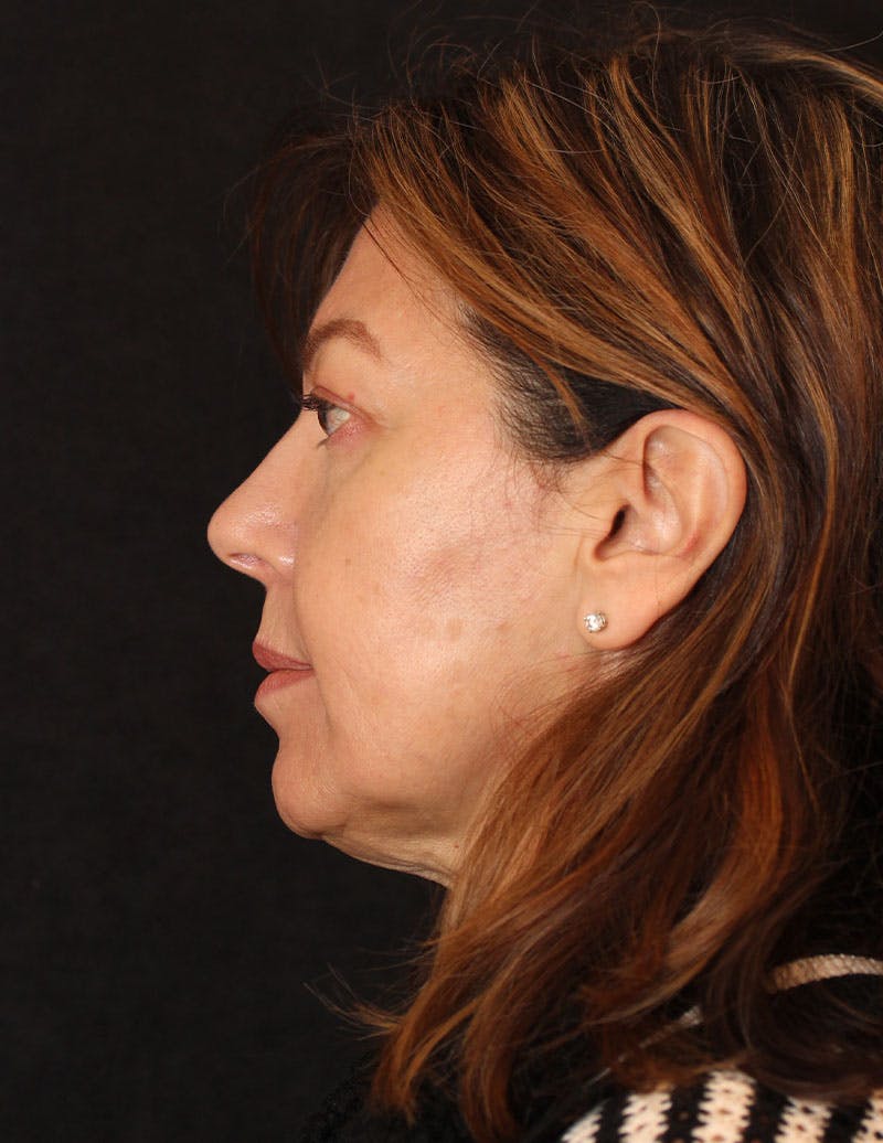 Facelift/Necklift Before & After Gallery - Patient 364144 - Image 7