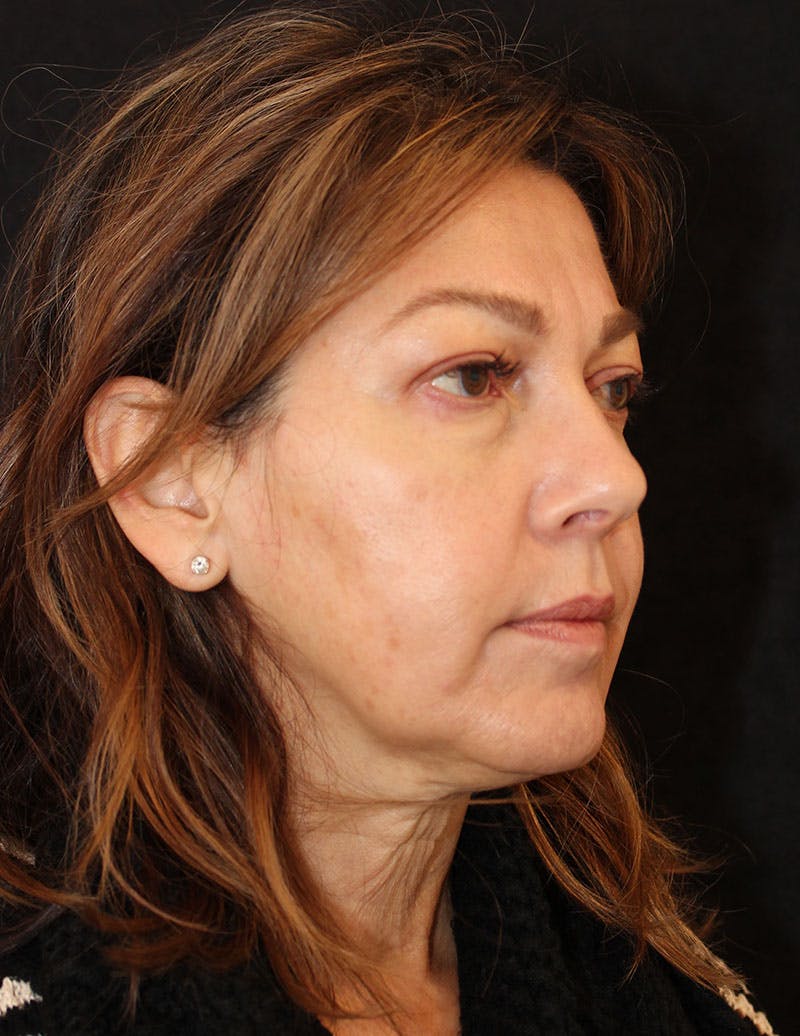 Facelift/Necklift Before & After Gallery - Patient 364144 - Image 3