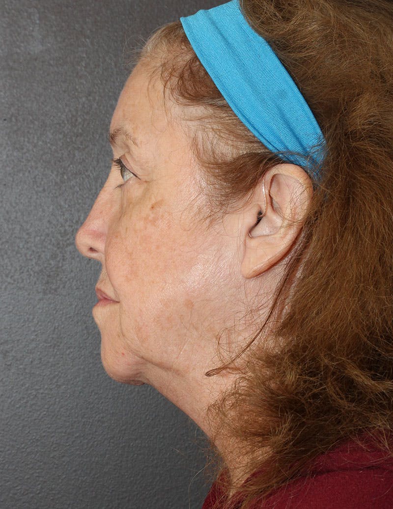 Facelift/Necklift Before & After Gallery - Patient 497115 - Image 7