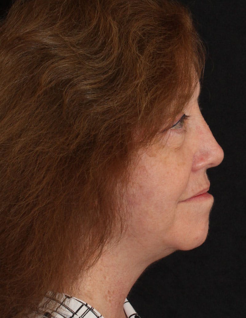 Facelift/Necklift Before & After Gallery - Patient 497115 - Image 6