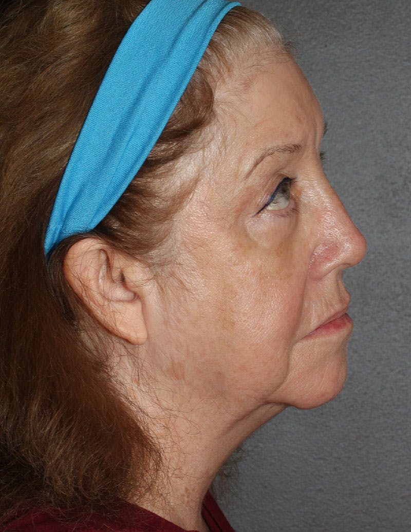 Facelift/Necklift Before & After Gallery - Patient 497115 - Image 3