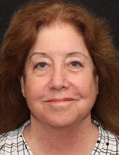 Facelift/Necklift Before & After Gallery - Patient 497115 - Image 2