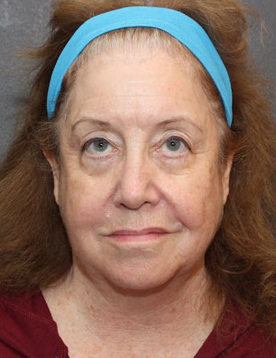 Facelift/Necklift Before & After Gallery - Patient 497115 - Image 1