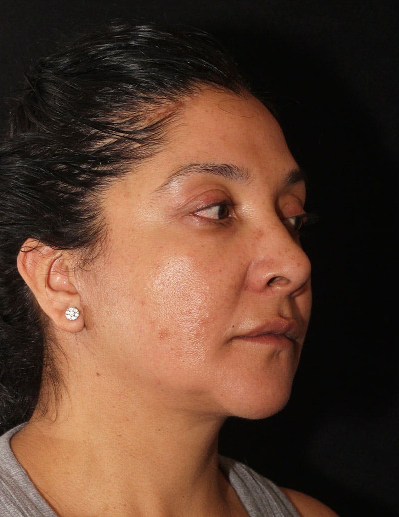 Facelift/Necklift Before & After Gallery - Patient 326907 - Image 4