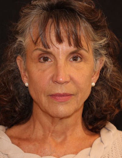 Facelift/Necklift Before & After Gallery - Patient 152823 - Image 1
