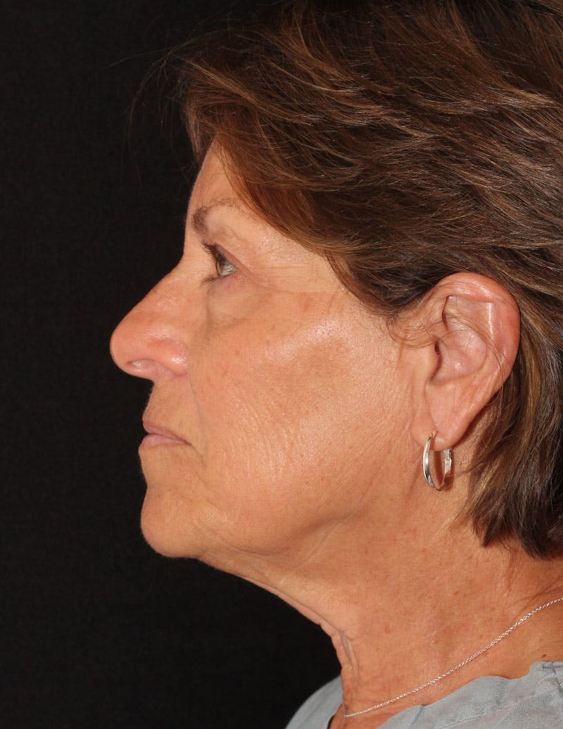 Facelift/Necklift Before & After Gallery - Patient 158286 - Image 8