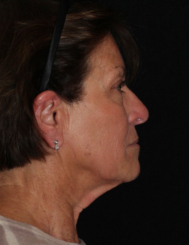 Facelift/Necklift Before & After Gallery - Patient 158286 - Image 5