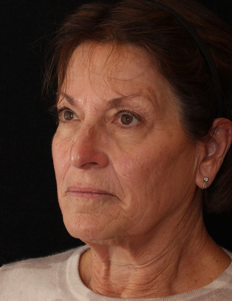 Facelift/Necklift Before & After Gallery - Patient 158286 - Image 9