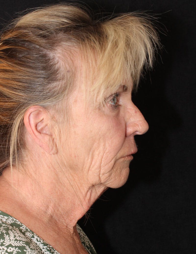 Facelift/Necklift Before & After Gallery - Patient 277135 - Image 6