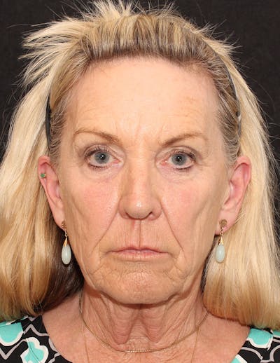 Facelift/Necklift Before & After Gallery - Patient 277135 - Image 1
