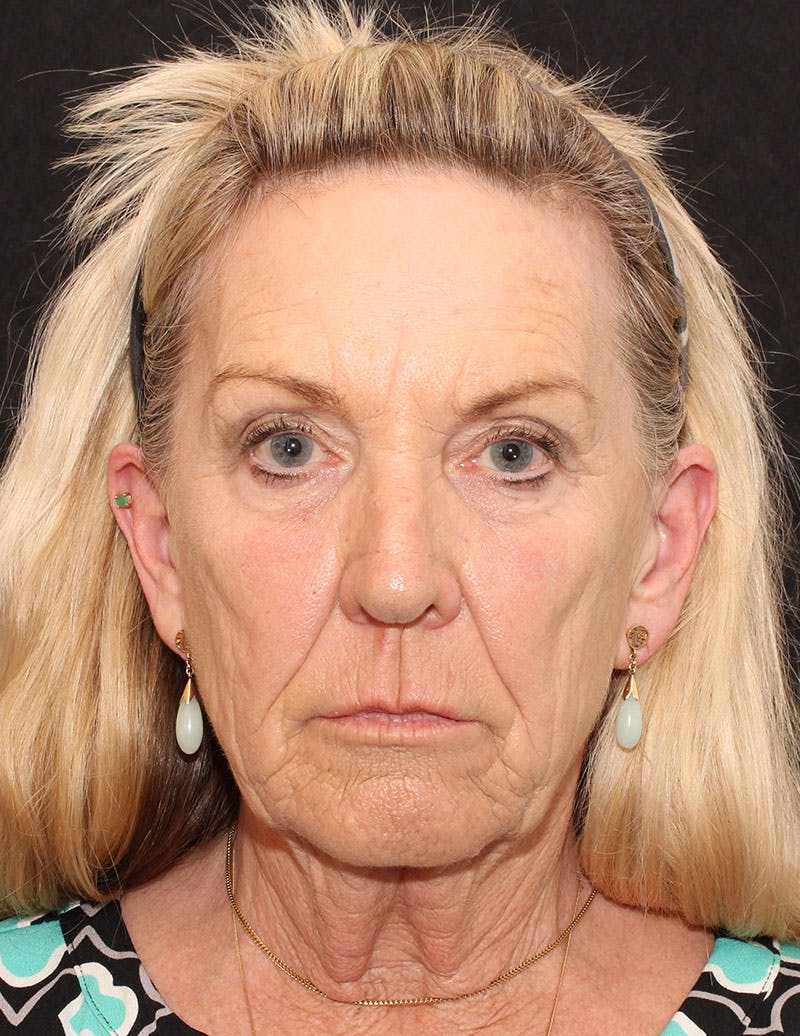 Facelift/Necklift Before & After Gallery - Patient 277135 - Image 1