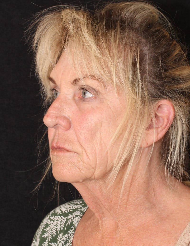 Facelift/Necklift Before & After Gallery - Patient 277135 - Image 10