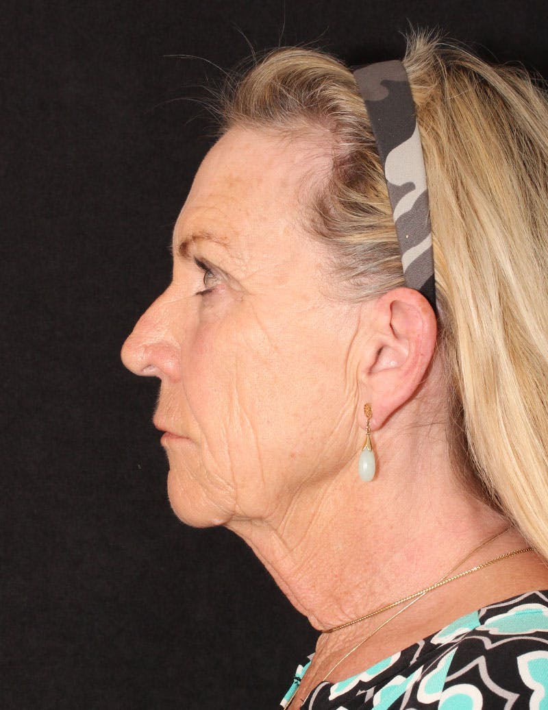 Facelift/Necklift Before & After Gallery - Patient 277135 - Image 7