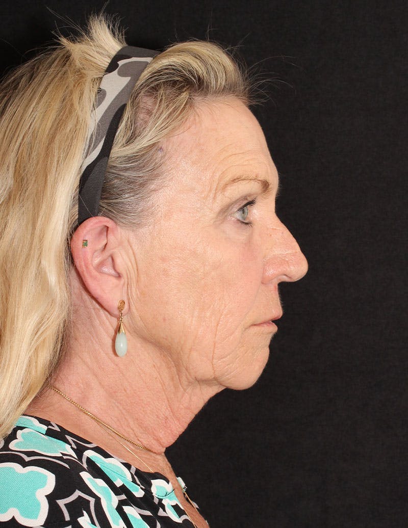 Facelift/Necklift Before & After Gallery - Patient 277135 - Image 5