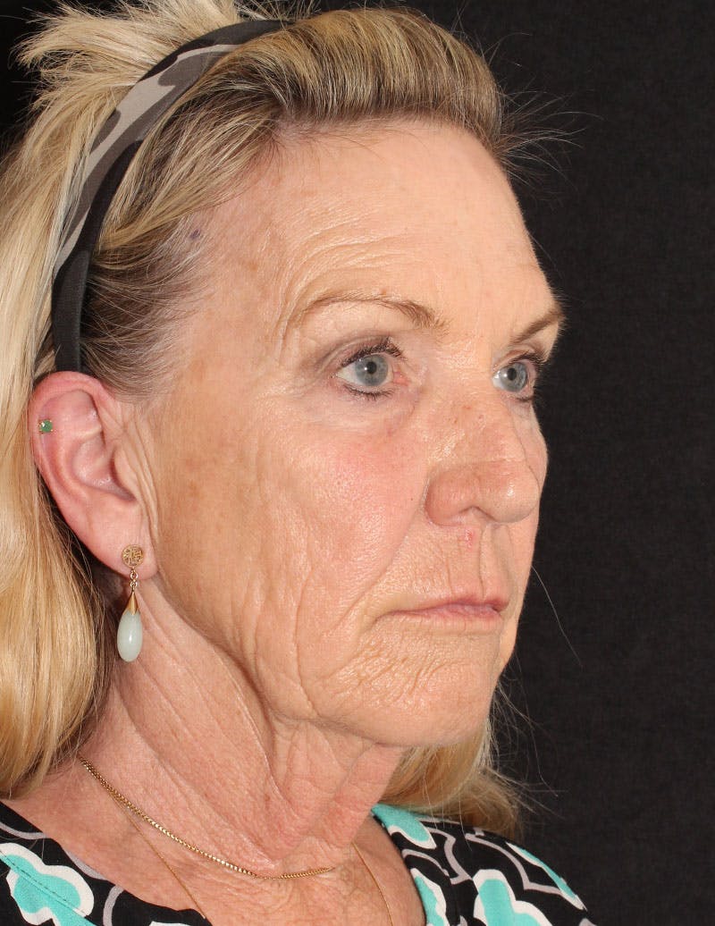 Facelift/Necklift Before & After Gallery - Patient 277135 - Image 3