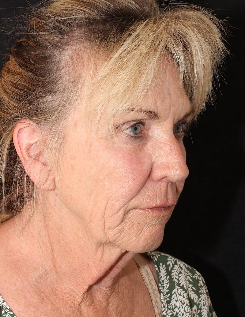 Facelift/Necklift Before & After Gallery - Patient 277135 - Image 4