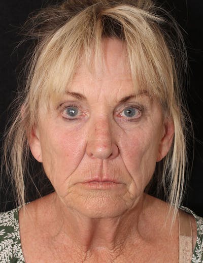 Facelift/Necklift Before & After Gallery - Patient 277135 - Image 2