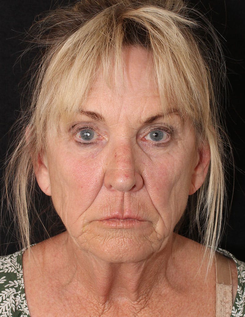 Facelift/Necklift Before & After Gallery - Patient 277135 - Image 2