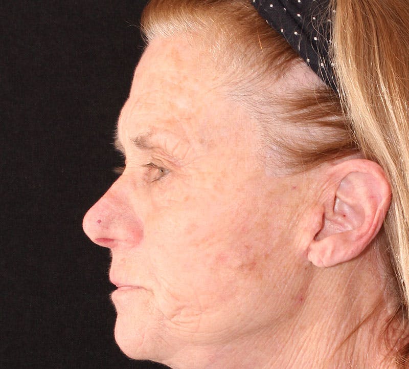 Browlift/Upper Blepharoplasty Before & After Gallery - Patient 140714 - Image 7