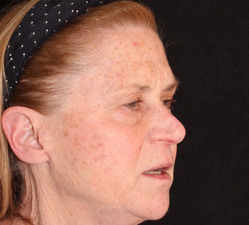 Browlift/Upper Blepharoplasty Before & After Gallery - Patient 140714 - Image 3