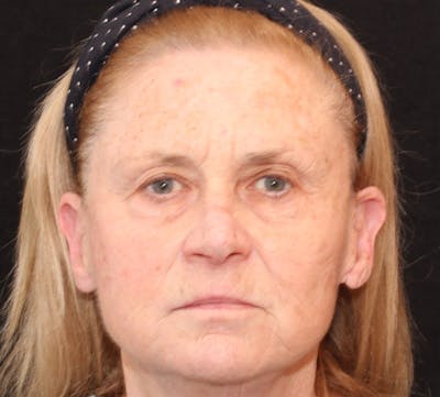 Browlift/Upper Blepharoplasty Before & After Gallery - Patient 140714 - Image 1