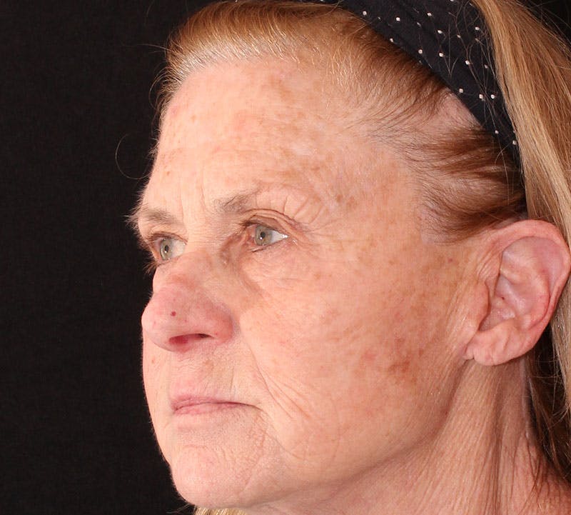 Browlift/Upper Blepharoplasty Before & After Gallery - Patient 140714 - Image 9