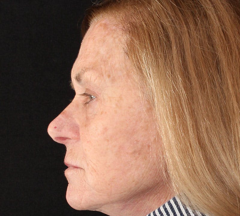 Browlift/Upper Blepharoplasty Before & After Gallery - Patient 140714 - Image 8