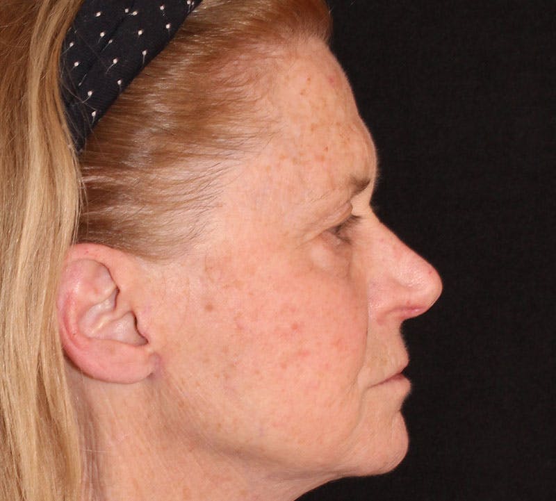 Browlift/Upper Blepharoplasty Before & After Gallery - Patient 140714 - Image 5