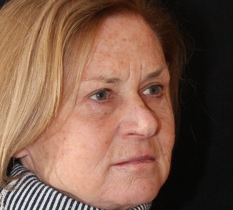 Browlift/Upper Blepharoplasty Before & After Gallery - Patient 140714 - Image 4