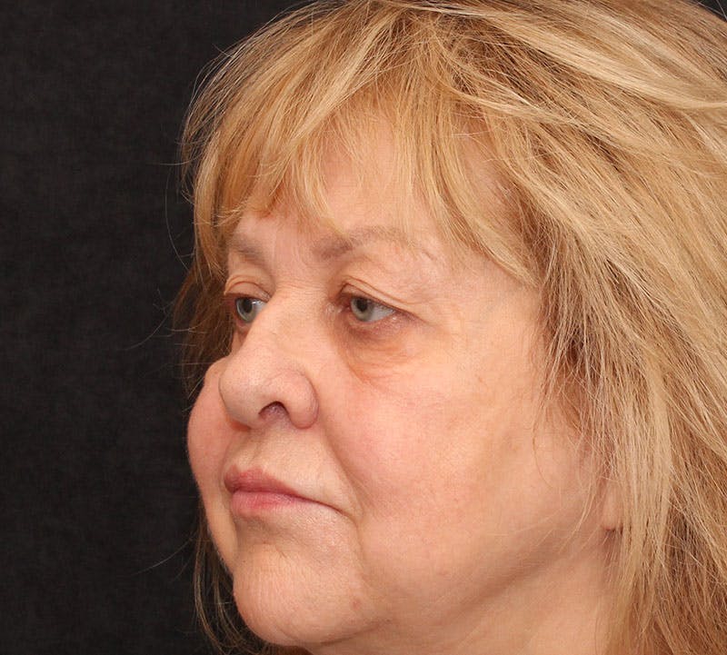 Browlift/Upper Blepharoplasty Before & After Gallery - Patient 377962 - Image 9
