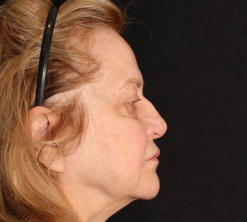 Browlift/Upper Blepharoplasty Before & After Gallery - Patient 377962 - Image 6