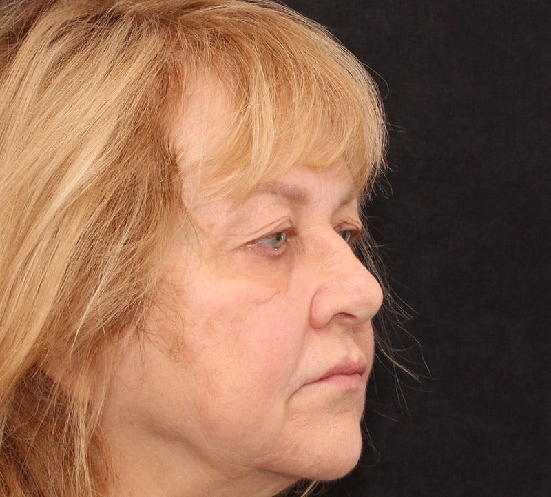 Browlift/Upper Blepharoplasty Before & After Gallery - Patient 377962 - Image 3