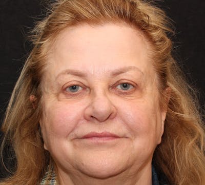 Browlift/Upper Blepharoplasty Before & After Gallery - Patient 377962 - Image 2