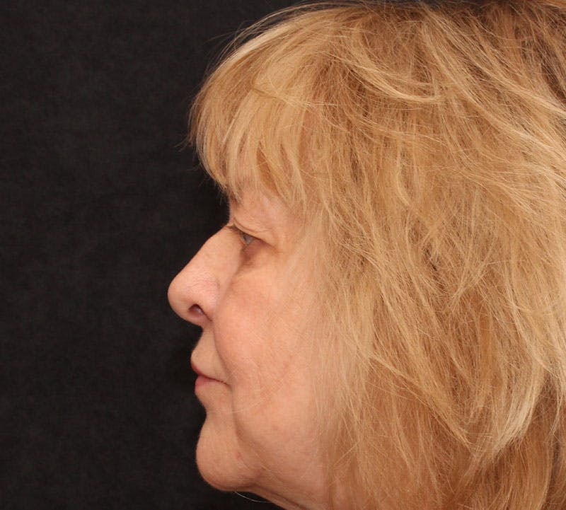 Browlift/Upper Blepharoplasty Before & After Gallery - Patient 377962 - Image 7