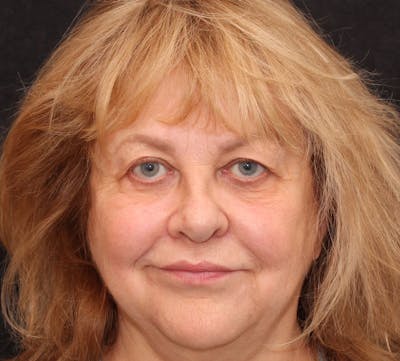 Browlift/Upper Blepharoplasty Before & After Gallery - Patient 377962 - Image 1