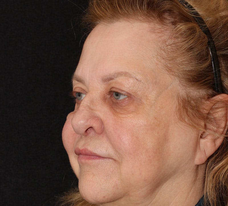 Browlift/Upper Blepharoplasty Before & After Gallery - Patient 377962 - Image 10