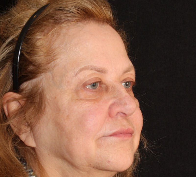 Browlift/Upper Blepharoplasty Before & After Gallery - Patient 377962 - Image 4
