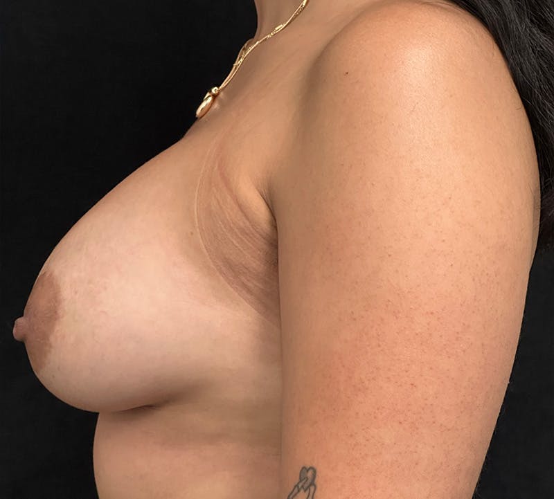 Breast Augmentation Before & After Gallery - Patient 294274 - Image 8