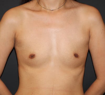 Nipple Inversion Before & After Gallery - Patient 324168 - Image 1