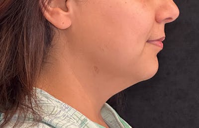 MyEllevate Before & After Gallery - Patient 335891 - Image 1