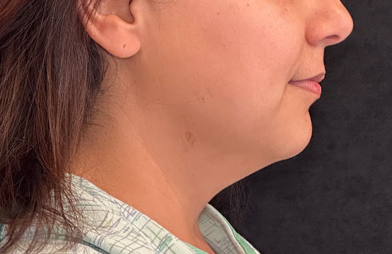 MyEllevate Before & After Gallery - Patient 335891 - Image 5