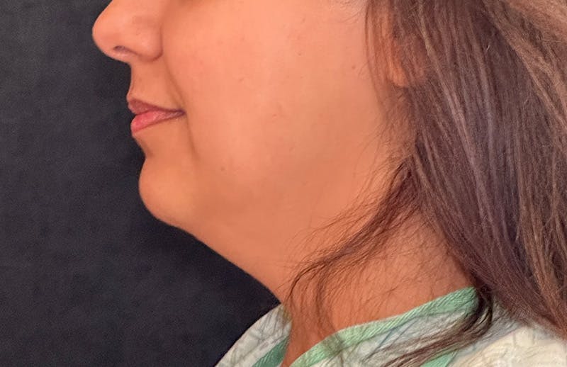 MyEllevate Before & After Gallery - Patient 335891 - Image 9