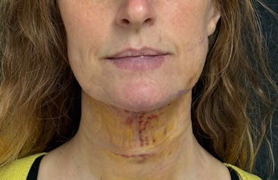 MyEllevate Before & After Gallery - Patient 349373 - Image 2