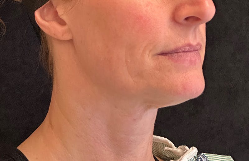 MyEllevate Before & After Gallery - Patient 349373 - Image 3