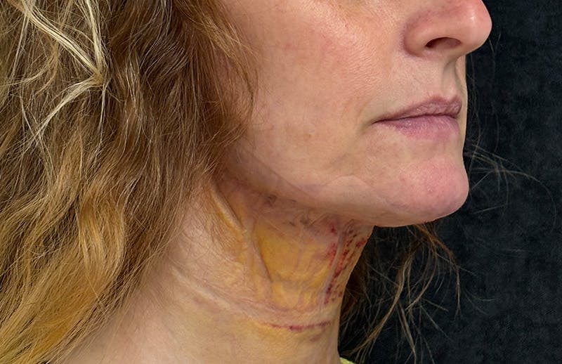 MyEllevate Before & After Gallery - Patient 349373 - Image 4