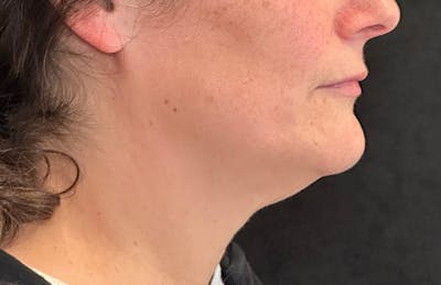 MyEllevate Before & After Gallery - Patient 133623 - Image 1