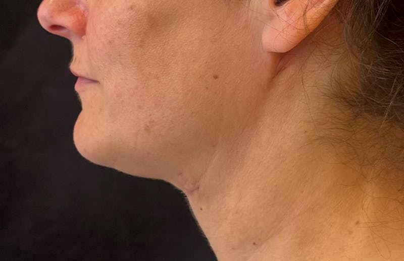 MyEllevate Before & After Gallery - Patient 133623 - Image 10