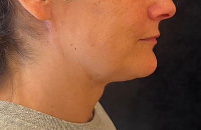 MyEllevate Before & After Gallery - Patient 133623 - Image 2
