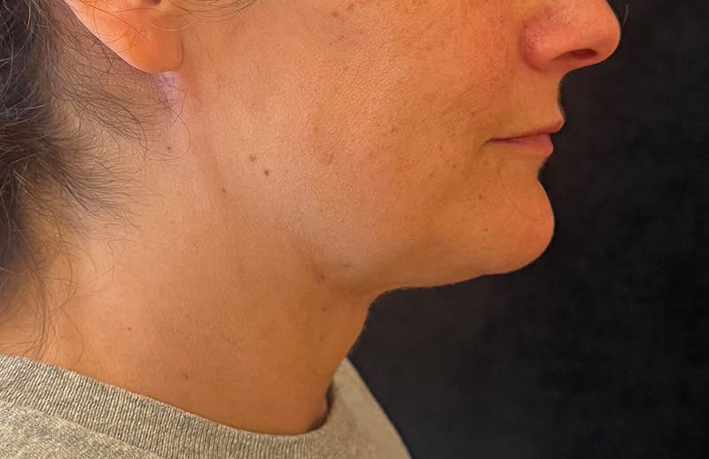 MyEllevate Before & After Gallery - Patient 133623 - Image 6