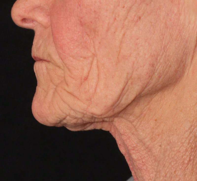 Ellacor Before & After Gallery - Patient 212935 - Image 3